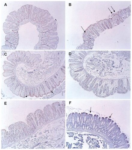 Figure 4 Variability in maspin expression in non-neoplastic colonic mucosa obtained from normal subjects and patients with colonic tumors (4× objective). (A) Normal mucosa obtained from a healthy patient during routine colonoscopy. This image shows a low overall expression of maspin; (B) normal mucosa obtained from a healthy patient during routine colonoscopy. This image shows focal staining in individual cells (arrows); (C) normal mucosa obtained from a colon resection from a patient who had a sarcoma surgically removed. The sarcoma was external to the body wall and the patient had received no prior radiation or chemotherapy. This image shows low overall staining predominantly at the top of the crypts (arrows); (D) region of colon 2 cm proximal to a large tubulovillous adenoma. This image shows a low overall expression of maspin; (E) region of colon 2 cm proximal to a large tubulovillous adenoma. This image shows a low overall expression of maspin; (F) region of colon near the distal margin of a colon resection from a patient with a colon cancer. This image shows low overall staining predominantly at the top of the crypts (arrows).