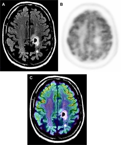 Figure 2 Radiation necrosis versus viable tumor on MRI.Notes: Sixty-nine-year-old male with glioblastoma multiforme, status post-chemotherapy presented with dizziness. Contrast MRI and 18F-FDG PET were performed to evaluate for progression. Post-contrast T1 MR (A) is suggestive of rim enhancement of tumor (arrow). 18F-FDG PET (B) and PET-MR fusion (C) images show an area of relatively decreased activity corresponding to the area of rim enhancement. PET findings were diagnostic for nonviable tissue. In this case, MR was unable to differentiate between radiation changes and viable tumor.Abbreviations: FDG, 2-fluorodeoxyglucose; MR, magnetic resonance; MRI, magnetic resonance imaging; PET, positron emission tomography.