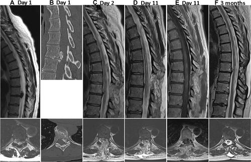 Figure 1 Evolvement of imaging finding. T2-weighted (A, C, D and F) and T1-weighted contrast- enhanced (E) magnetic resonance images and CT-image (B). (A and B) Day 1: calcified Th8–9 disc herniation without cord abnormalities; (C) Day 2 (post-surgery): multiple hyperintense intramedullary lesions; (D) Day 11: T2 hyperintense lesion in the posterior cord (E) that shows partial contrast enhancement; (F) 3 Months: cord abnormalities have decreased.