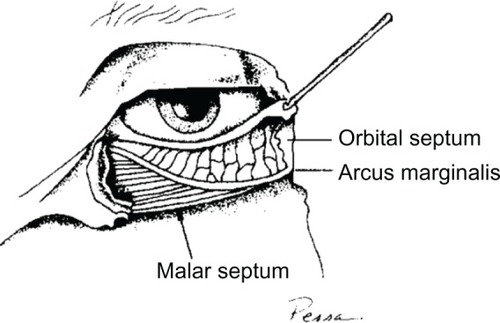 Figure 4 The anatomic basis of malar edema.