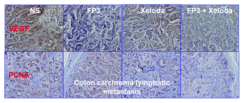 Figure 7. Effects of FP3 and capecitabine (Xeloda) on the expression of VeGF and PCNA in the PDTT xenograft models of colon carcinoma lymphatic metastasis. Original magnifications, x100.