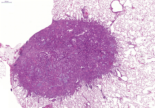 Figure 8.  Bronchiolo-alveolar carcinoma with metaplasia to goblet cells and mucin production after repeated intratracheal instillation of ultrafine amorphous SiO2 (Aerosil). H&E.