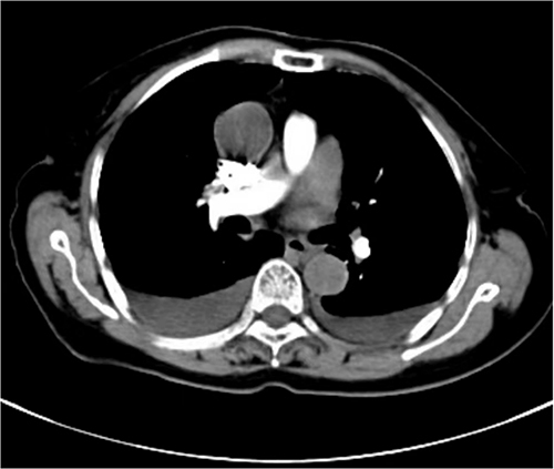 Figure 2 Chest computed tomography showing pleural fluid in both lungs.