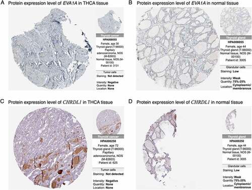 Figure 7. Immunohistochemical images of prognosis-related genes in cancer and normal tissues from the HPA database. (a, b) Abundance levels of EVA1A in (a) thyroid carcinoma (THCA) tissues (Antibody HPA008055; Staining: Not detected; Intensity: Negative; Quantity: None) and (b) normal thyroid tissues (Antibody HPA008055; Staining: Low; Intensity: Week; Quantity: 75%–25%). (c, d) Abundance levels of CHRDL1 in (c) THCA tissues (Antibody HPA000250; Staining: Not detected; Intensity: Negative; Quantity: None) and (d) normal thyroid tissues (Antibody HPA000250; Staining: Low; Intensity: Week; Quantity: 75%–25%)