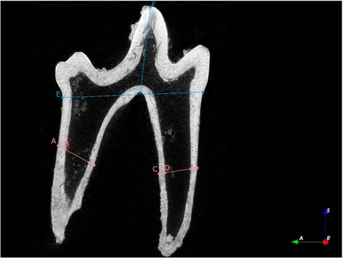 Figure 2. Measurements for pulp cavity closure ratios on mandibular M1s: A) width of the distal root; B) width of the pulp cavity for the distal root; C) width of the pulp cavity for the mesial root; D) width of the mesial root; E) width of the crown at CEJ; and F) crown height.