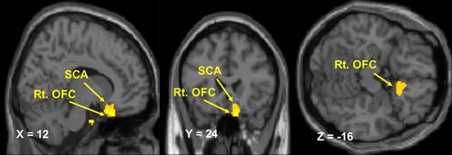 Figure 1 Resting-state functional connectivity of the left anterior insular cortex. Brain regions showing a significant increase in the functional connectivity of the left anterior insular cortex in patients with knee osteoarthritis relative to controls (p < 0.001 uncorrected, peak-level and p < 0.05 cluster-level, after FWE correction).