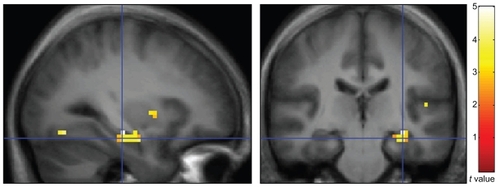 Figure 1 Sagittal (left) and coronal (right) views of BOLD response during the fMRI auditory sensory gating paradigm (contrast: AD subjects > healthy comparison subjects). These responses are overlaid on an average anatomical image constructed using data acquired from healthy comparison subjects and employ radiological convention (right on left).Abbreviations: BOLD, blood oxygen level-dependent; fMRI, functional magnetic resonance imaging; AD, Alzheimer’s disease.