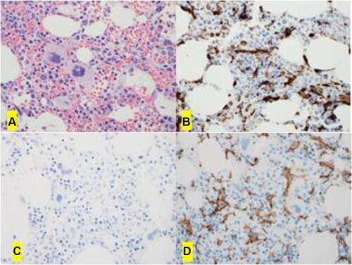 Figure 1 The bone marrow biopsy shows hypercellularity with increased megakaryocytes (A, H&E x40). The immunohistochemical studies show increased interstitial macrophages by CD68 (PGM1) (B, x40); and they are type 2 macrophages negative for pSTAT1 (C, x 0) but positive for CD163 (D, x40).
