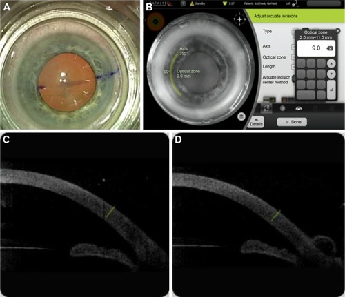 Figure 1 Basic procedure: place incisions, (A) align suction ring, (B) set parameters, (C and D) confirm 3D depth with optical coherence tomography.