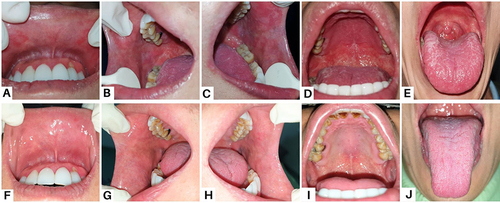 Figure 2 Clinical features of the patient in Case 2 (A–E) On the first visit, white spots on the dorsal tongue and erythematous areas (F–J) The lesions have improved after one month.