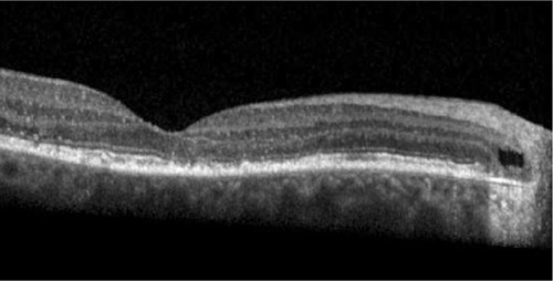 Figure 3 Beneath a cystic space in the outer peripapillary retina.