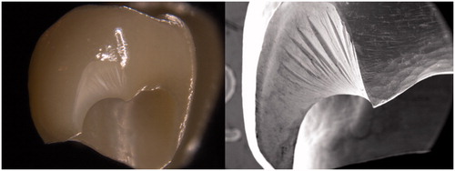 Figure 5. Failure mode. A typical semilunar margin fracture similar to the clinical case observed on a thick glazed crown in light microscope (left) and in SEM (right).