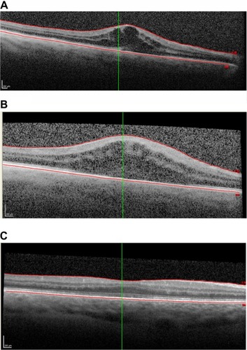 Figure 2 Images of plaque brachytherapy.