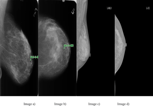 Figure 1. Examples of breast cancer screening images of a patient. Image a), Image b), Image c) and image d).