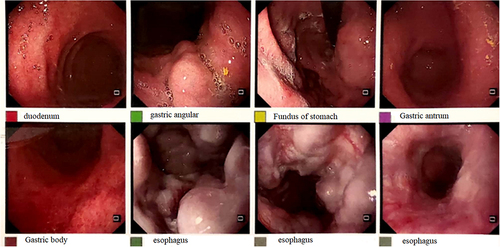 Figure 4 Gastroscopy: gastroesophageal varices (severe), portal hypertensive gastropathy.
