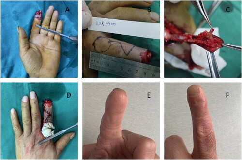 Figure 2. Typical case presentation. An Allen’s type 3 fingertip amputation is shown in (A). The exact location and width of flap and broaden pedicle is shown in (B). During operation, we dissected the digital nerve in the flap (C). Postoperative status was shown in (D). At 18 months follow-up, the index finger showed good contouring and appearance (E and F).