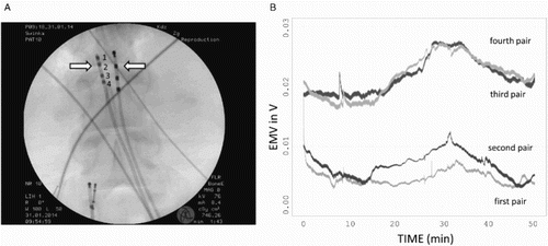 Figure 1 The placement of electrodes and alignment of their signal. (A) Arrows indicate which pair of electrodes was used for measurement in the majority of experiments. Four pairs were used for multiple channel monitoring. (B) Alignment of the signal for the experiments with multiple channel vmonitoring.