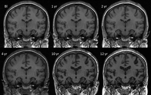 Figure 1. Mid-temporal axial volumetric T1-weighted MR images acquired at initial presentation and subsequent repeat visits (1-, 2-, 4-, 10-, and 12-year follow-up). All repeat images have undergone 12 degrees of freedom registration to spatially align them to the baseline (Bl).