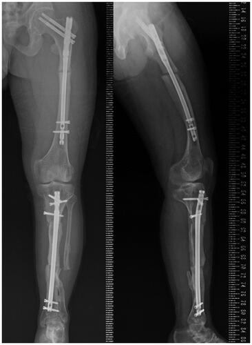 Figure 9. Postoperative long-leg standing radiograph of the left lower leg in antero-posterior and lateral views.