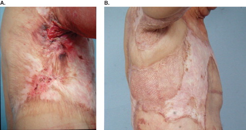 Figure 1. (A) Burn scar cancer at the axilla; (B) after wide excision and local flap and skin grafting. Tumor-free for 7 years to present.