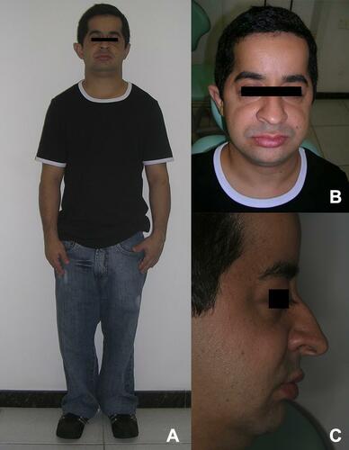 Figure 1 Body aspect (A), frontal aspect (B) and lateral aspect (C) of the patient.