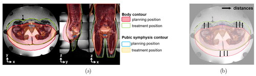 Figure 6. (a) Representation of the body contour and pubic symphysis contour in the planning and treatment position (as in Figure 4a); (b) illustration of the closest distances from all surface points on the body contour in the planning position to the points on body contour in the real treatment position. Note that the top and bottom distances are defined as surface distances. In addition, the x-, y- and z-direction are demonstrated together with the different anatomical planes.