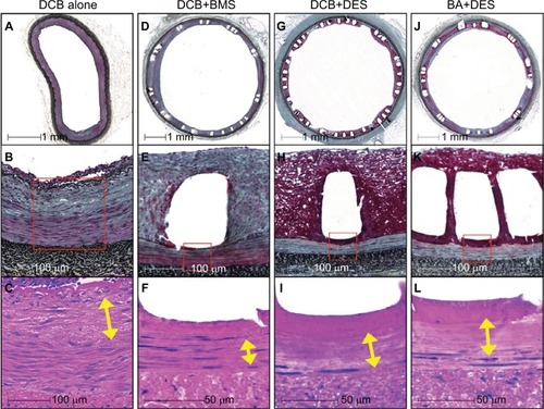 Figure 4 Representative histologic images of the biologic responses to DCB + DES, BA + DES, DCB + BMS, and DCB alone in swine iliofemoral arteries.Source: Reprinted from Journal of Vascular and Interventional Radiology, 29, Sho Torii,Kazuyuki Yahagi, Hiroyoshi Mori, Emanuel Harari, Maria E. Romero, Frank D. Kolodgie, Brandt Young, Anthony Ragheb, Renu Virmani, Aloke V. Finn, Biologic drug effect and particulate embolization of drug-eluting stents versus drug-coated balloons in healthy swine femoropopliteal arteries, 1041–1049., © 2018, with permission from Elsevier.Citation61