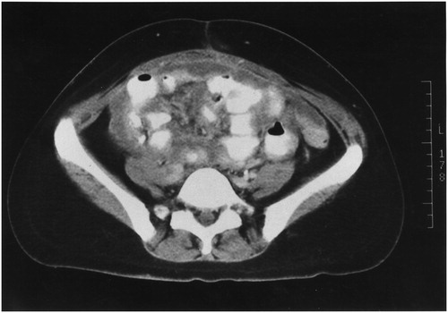 Figure 1. CT slice showing bowel obstruction or partial obstruction at more than one site (chaotic bowel pattern).
