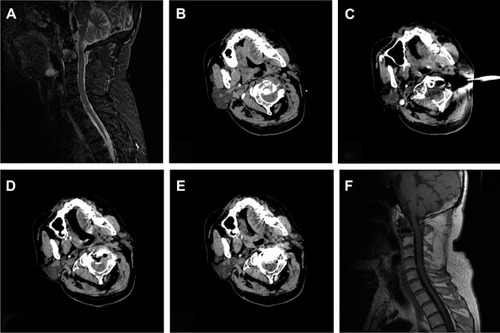 Figure 2 PVP using a CT-guided translateral approach via the space between the carotid sheath and vertebral artery in a patient with NSCLC with metastasis to C2.