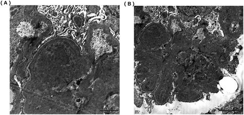 Figure 2. Electron microscope of renal biopsy specimens. (A) Electron microscope shows the electric-dense deposits in the mesangial area (×12,000). (B) Electron microscope shows the electric-dense deposits in subendothelial areas of glomeruli (×6000).