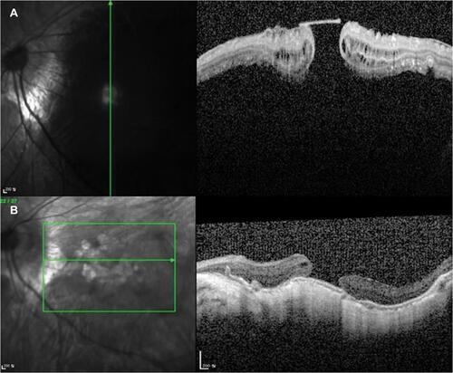 Figure 4 Pre- and postoperative OCT image of a 71-year-old woman (case 1). (A) MHRD with ERM is seen on preoperative OCT. The excavation of the posterior sclera was too deep to be captured simultaneously. (B) 30 months postoperative OCT shows reattachment of the retina with persistent MH. The buckle effect is well noticed on the OCT.
