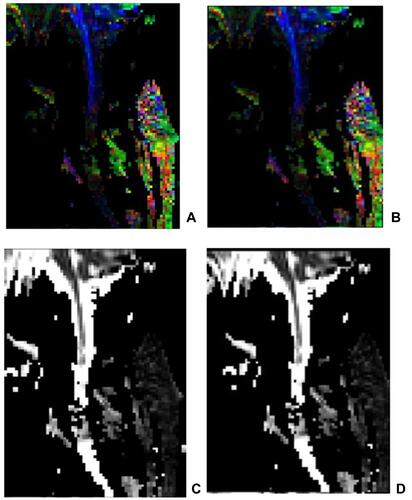 Figure 4 The FA image and the ADC image in a patient with complete cervical SCI. (A) FA image before the treatment; (B) FA image after the treatment; (C) ADC image before the treatment; (D) ADC image after the treatment. After scanning, DTI images were transmitted to Siemens workstation for post-processing to generate sagittal DTI images of spinal cord, including ADC and FA images. In the zoom and 3D mode of DTI post-processing window, ROI of the same size (about 2 ~ 3 pixels) was placed in the center of the spinal cord lesion area at the selected spinal cord level, and the ADC value and FA value were measured.