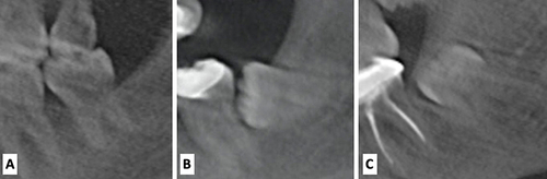 Figure 3 Pell & Gregory’s classification of ramus relation and impaction depth of lower third molars, (A) Class 1, Level A, (B) Class 2 Level B, (C) Class 3 Level C.