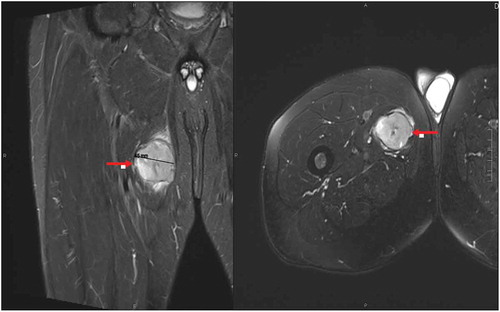 Figure 1. T2 MRI scan of the right thigh showing 4.5 cm mass (red arrows) within the adductor brevis muscle with mild surrounding edema.