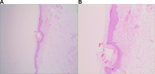 Figure 3 Histologic section showing dermal vessels and periadnexal lymphocytic focal infiltrate (A. H&E, ×40; B. H&E, ×100).