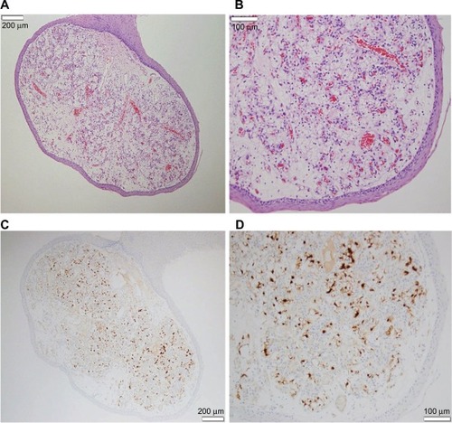 Figure 1 Slides of metastatic renal cell carcinoma (RCC) to the uvula.