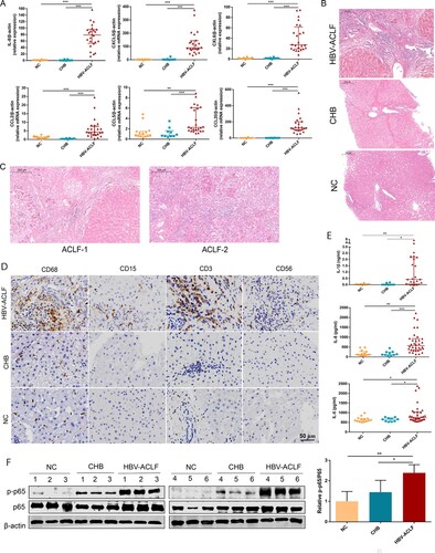 Figure 4. The liver of HBV-ACLF patients exhibited significantly increased chemokines, a large number of inflammatory cell infiltration and high activation of the NF-ĸB pathway. (A) The qRT-PCR validation of 10 key chemokine genes (n = 24/10/14, ACLF/CHB/NC groups, respectively). (B,C) Liver HE staining in patients from the HBV-ACLF, CHB, and NC groups. (D) Immunohistochemical staining of T lymphocytes (CD3), macrophages (CD68), neutrophils (CD15), and NK cells (CD56) in the liver of patients from the HBV-ACLF, CHB, and NC groups. (E) ELISA results of plasma IL-6, IL-8, and IL-1β in HBV-ACLF, CHB patients, and NC. Plot, medians with (p25, p75). The Kruskal–Wallis test, *p < 0.05, **p < 0.01 and ***p < 0.001. (F) Immunoblot analysis of HBV-ACLF, CHB, and NC livers for p-P65 and P65. Abbreviations: ACLF, acute-on-chronic liver failure; CHB, chronic hepatitis B; DEGs, differentially expressed genes; HBV, hepatitis B virus; LC, liver cirrhosis; NC, normal controls; HE; RT-PCR;