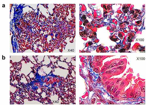 Figure 7. Pulmonary sequelae in SARS-Cov-2 infected HIS-DRAGA mice.