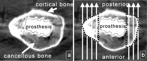Figure 2.  Separate circumferential evaluation of cortical and cancellous BD (mg CaHA/mL) with CT-assisted osteodensitometry (a) compared to the analysis of single zones of interest (dotted lines) in the AP view with DXA (b).