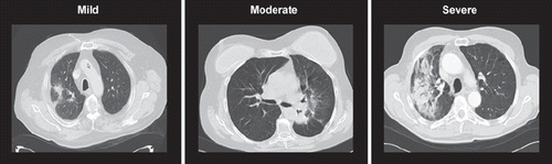 Figure 1. Examples of radiological pneumonitis scored as mild, moderate, or severe.