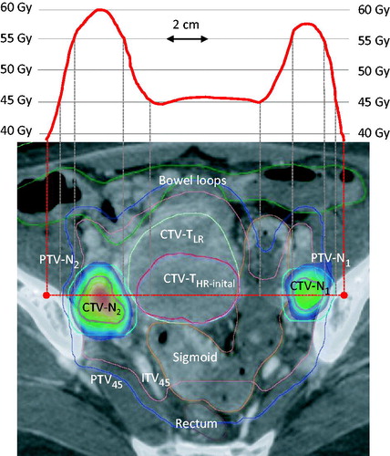 Figure 1. Coverage probability based treatment plan for simultaneous integrated boost of two pathological nodes behind the external iliac vessels (CTV-N1 and CTV-N2) with 55 Gy/25 fx combined with whole pelvic and para-aortic 45 Gy/25 fx using VMAT in a patient with stage IVB disease. The patient had five additional nodes (N3–N7) at higher levels all boosted to 57.5 Gy (not shown). The dose profile across the pelvis is shown in the upper panel. The tumour related targets GTV-Nn, GTV-T (not shown), CTV-THR-initial and CTV-TLR were contoured on MRI and merged with CT (lover panel). In this case, GTV-T was identical to CTV-THR-initial as the whole cervix was tumour infiltrated. CTV-Nn was obtained by fusing GTV-NMRI and GTV-NCT. ITV45 was contoured taking into account the possible movement of the GTV-T, CTV-THR-initial and CTV-TLR as judged from target movements observed between MRI, CT full and CT empty bladder. The margin for PTV-Nn and PTV45 was 5 mm. The rectum, sigmoid and outer contour of bowel and other relevant organs (not shown on this slide) were contoured on CT. Notice the homogenous 45 Gy dose plateau in the central pelvis where brachytherapy was later applied. The colour wash represents the range 52.3 Gy (95% of 55 Gy) to 59.8 Gy (Dmax of CTVN2).