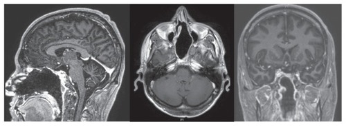 Figure 4 Brain magnetic resonance imaging performed 6 years after surgery, demonstrating the absence of tumor relapse and no foreign body granuloma formation.