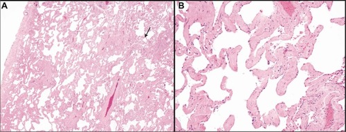 Figure 1 (A) Smoking-related interstitial fibrosis involving subpleural lung parenchyma (pleural surface is at the left) with centrilobular accentuation (arrow); (B) thickening of the alveolar septa by dense, eosinophilic, paucicellular collagen bundles.