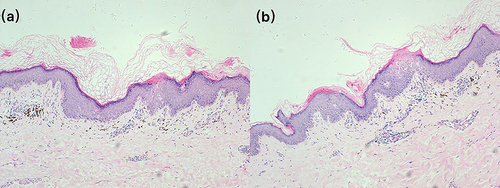 Figure 2 Pathological presentation of the patient. (HE, ×100). The epidermis is mildly hyperplastic, with several keratin-filled depressions showing a tendency to form a conical plate with vacuolated epithelial cells and a partial lack of a granular layer. Lymphocyte infiltration can be seen around dermal vessels (a and b).