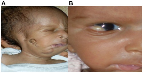 Figure 3 (A and B) Goldenhar syndrome (photo, André Omgbwa Eballé, Cameroon). (A) Mandibular hypoplasia and preauricular skin tag; (B) limbal dermoid in the same child.