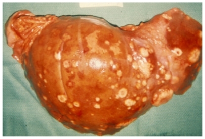 Figure 4 Photograph of metastatic breast cancer in liver. The lesions appear grossly as firm, white nodules, consistent with a host desmoplastic response and poor vascularization.Notes: The image is representative of the pathological descriptions in the autopsy cases in the study but is not an actual image from one of the cases. Photo provided courtesy of Drs Hanne Jensen and Robert D Cardiff, Center for Comparative Medicine, University of California, Davis.