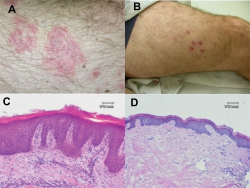 Figure 2 Clinical and histological response of subject in phase II study of adalimumab after 12 weeks. Clinical photos target lesion at day 0 (A) and day 84 (B) and representative histological specimens at day 0 (C) and day 84 (D).