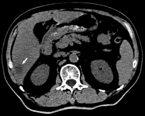 Figure 1 Abdominal CT scan showed a right lobe liver abscess (rounded, low density areas).