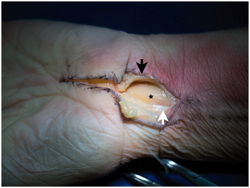 Figure 1. The incision in a cadaver. The previous incision is extended proximally and the carpal tunnel is opened. *: median nerve; Black arrow: ulnar leaf of flexor retinaculum; White arrow: palmaris longus tendon.