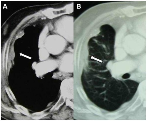 Figure 2 Axial computed tomography images of the right lung in the (A) mediastinal and (B) pulmonary window 9 years after initial examination show that the bulky side of the mesothelioma has slightly decreased.